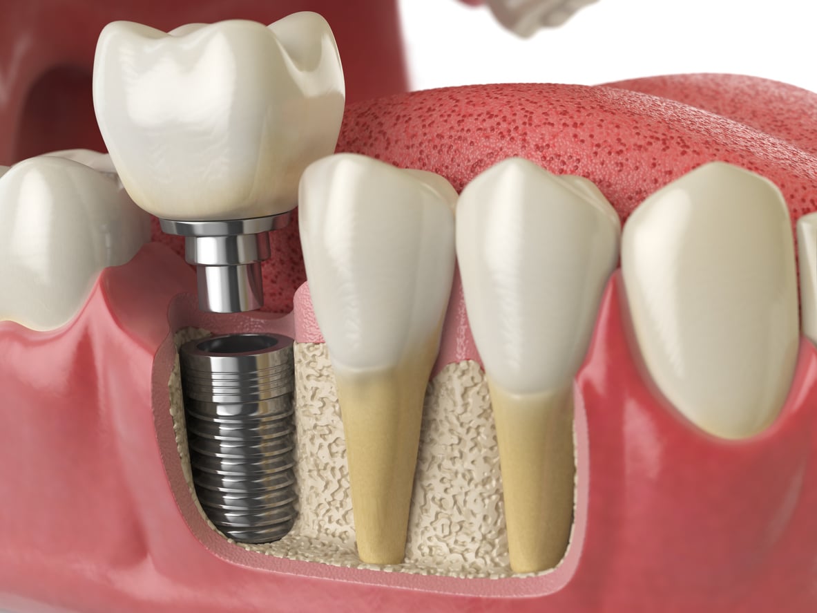 Easy Dental Implants: A Guide To Restoring Your Smile